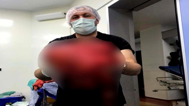14 kiloluk tümör ameliyatla alındı...